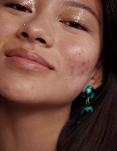 Acne