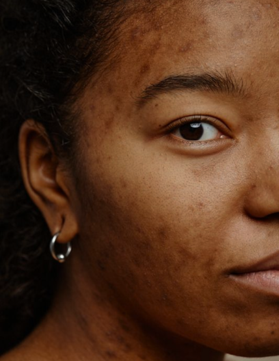 Hyperpigmentation
